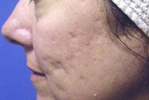 acne-littekens-huidenlaserkliniekzeeland