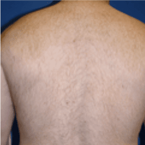 laserontharing-zeeland-huidenlaserkliniekzeeland2