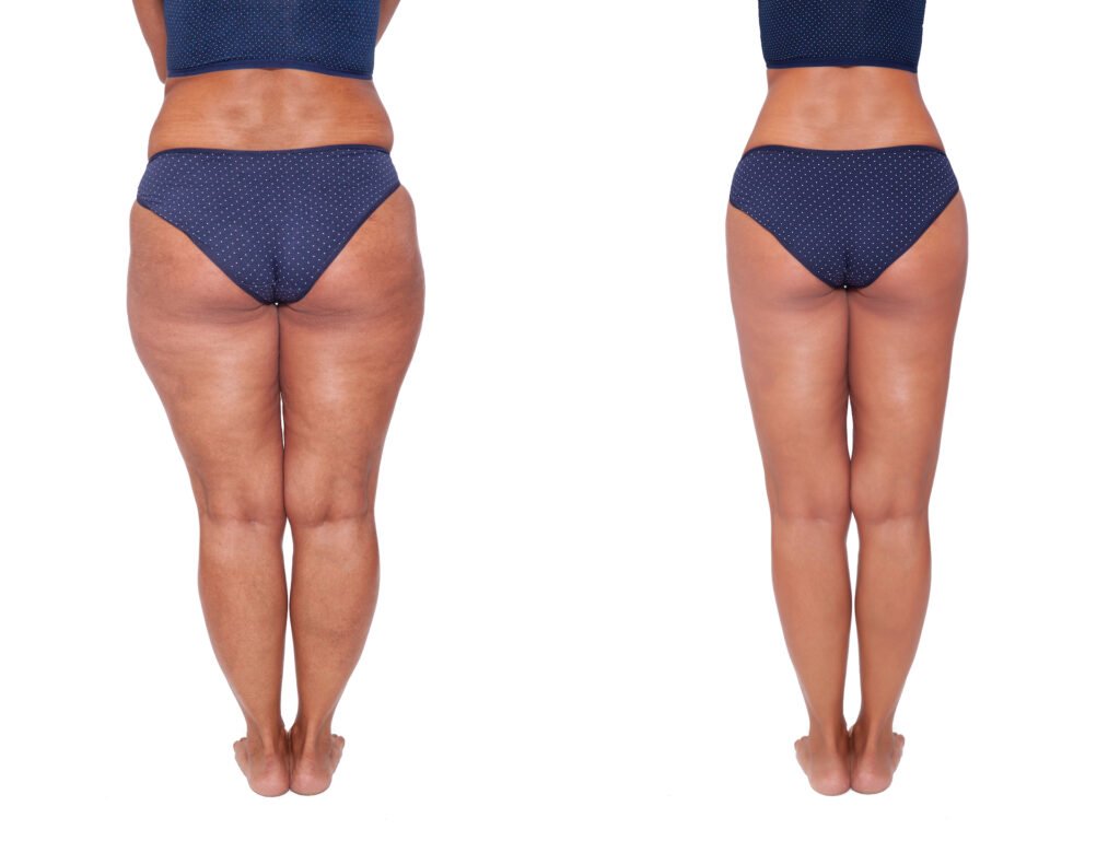 liposuctie-huidenlaserkliniekzeeland