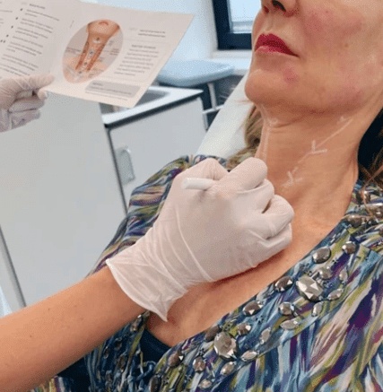 Profhilo-huidenlaserkliniekzeeland